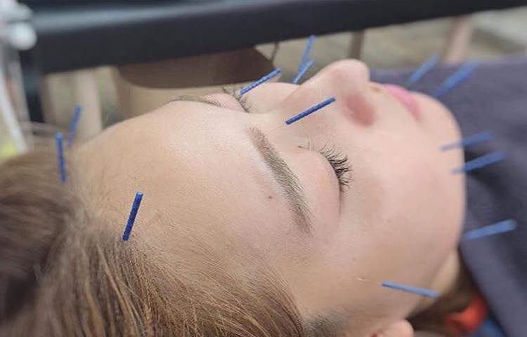 Điện châm điều trị rối loạn thần kinh chức năng sau chấn thương sọ não (Di chứng tổn thương đầu)